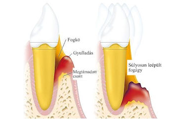 Hogyan szüntethető meg a rossz lehelet fogorvos nélkül? - alfastyle.hu