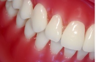 Gingival recession