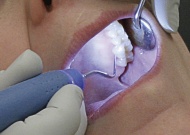 Dentálhigiénia - fogkő eltávolítása ultrahanggal, sópolírozás, professzionális homokfúvás