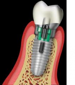 SYMPLANT magyar rendszer Fog szati rak Tour de Dental Az