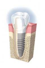 Implant Direct (amerikanisches System)