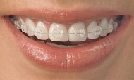 Zahnregulierung