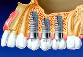 Rimozione di corona o ponte vecchi con taglio speciale senza trauma, in caso di altri denti pilastri