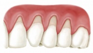 Die Ursachen der Herausbildung der Zahnbetterkrankungen und des Zahnfleischschwunds