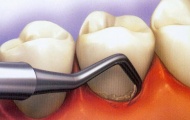 A  fogkő eltávolítás kezelés menete