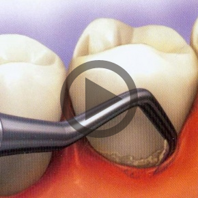 Video über die Zahnsteinentfernung
